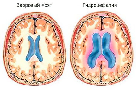 Intracranial pressure in newborns