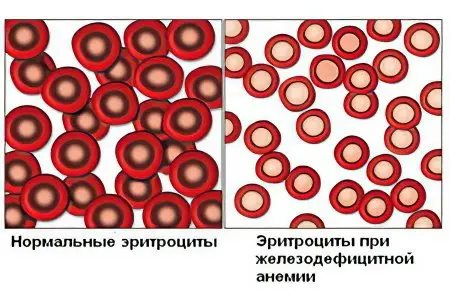 Iron deficiency anemia: what is it and how to treat it?