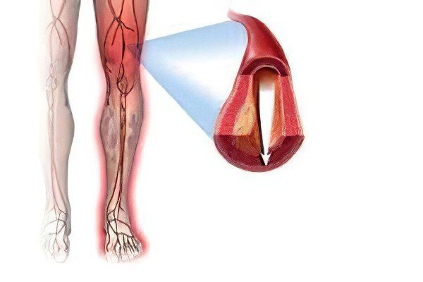 Ischemia of the lower extremities