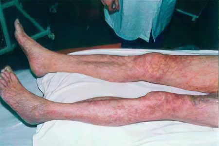 Ischemia of the lower extremities