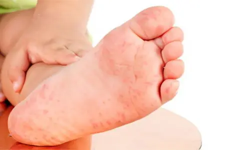 Itchy feet: what to do?