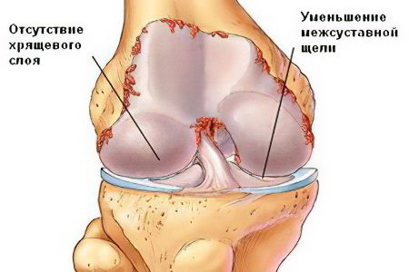 Joint diseases: types, symptoms and treatment