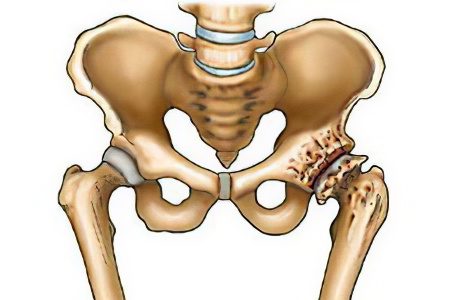 Joint diseases: types, symptoms and treatment