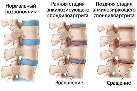 Joint diseases: types, symptoms and treatment