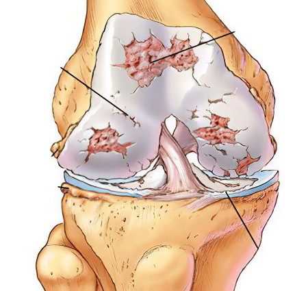 joint dysplasia