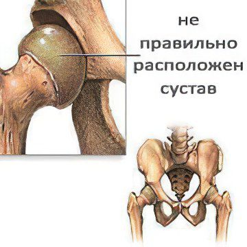 joint dysplasia