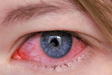 Keratitis: types, symptoms and treatment