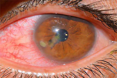 Keratitis: types, symptoms and treatment