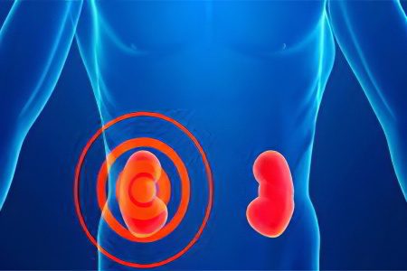 Kidney disease in men and women