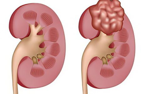 kidney lipoma