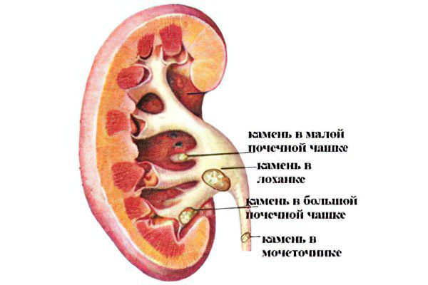 Kidney stones in women and men