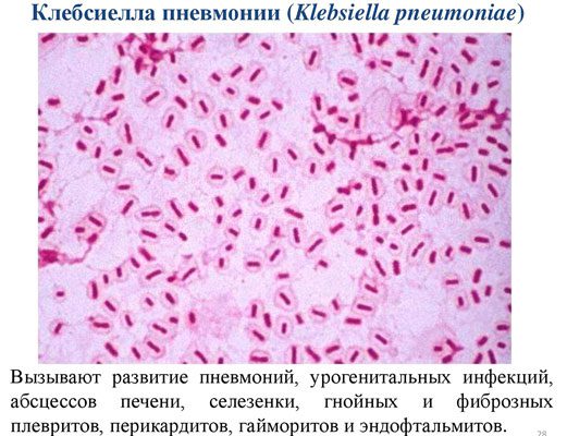 Klebsiella pneumonia: how dangerous is it and how is it treated?