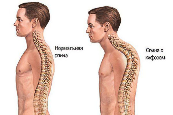 Kyphosis of the thoracic spine