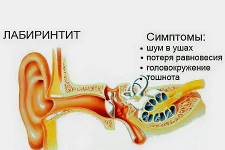 Labyrinthitis: symptoms and treatment