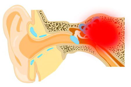 Labyrinthitis: symptoms and treatment