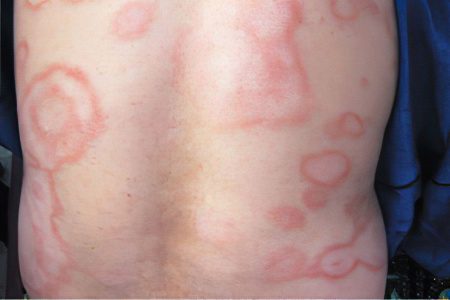 Leprosy (leprosy): what is this disease?