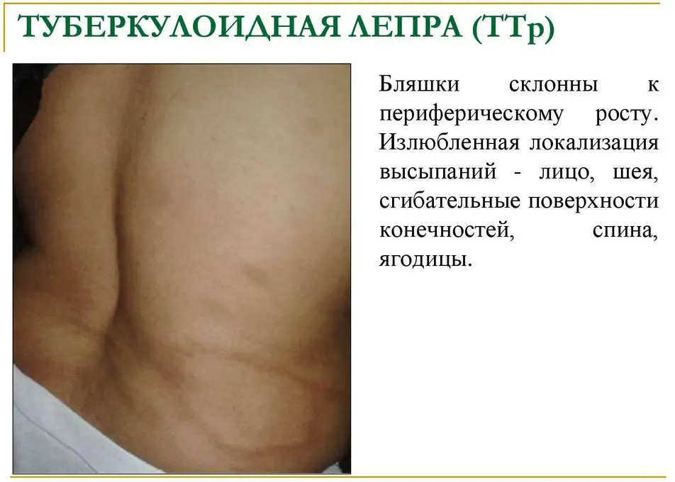 Leprosy (leprosy): what is this disease? Leprosy (leprosy): what is this disease?