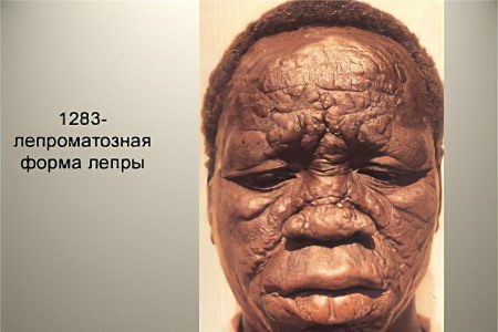 Leprosy (leprosy): what is this disease?