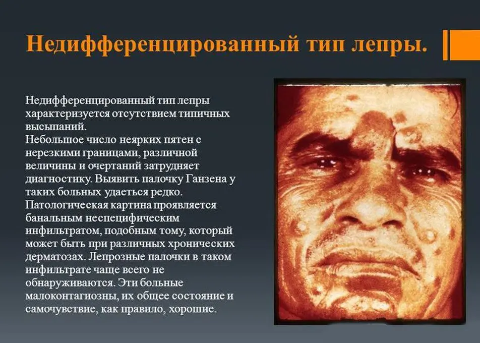 Leprosy (leprosy): what is this disease? Leprosy (leprosy): what is this disease?
