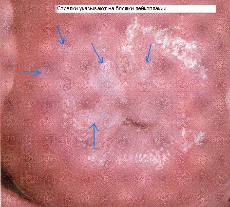 Leukoplakia of the cervix: symptoms and treatment