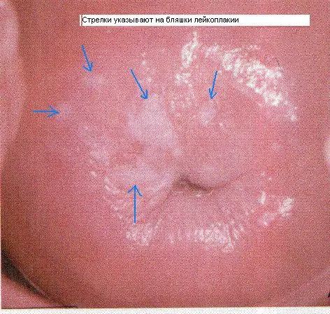 Leukoplakia of the cervix: symptoms and treatment