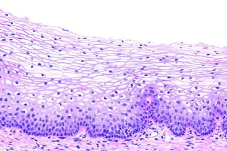 Leukoplakia of the cervix: symptoms and treatment