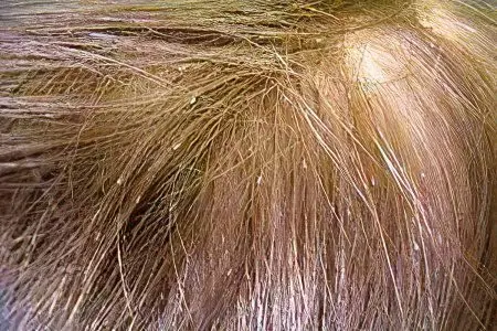 Lice on the head - what do lice look like? How to get rid of them?