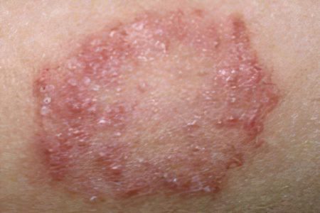 Lichen planus in humans