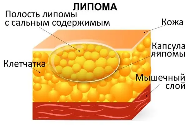 Lipoma &#8211; what is it and how to treat it?