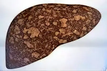 Liver steatosis