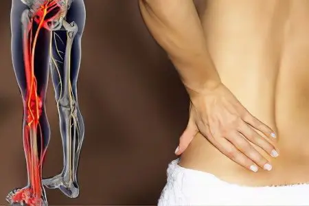 Lower back pain radiates to the leg