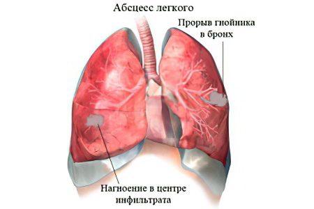 Lung abscess: what is it and how to treat?