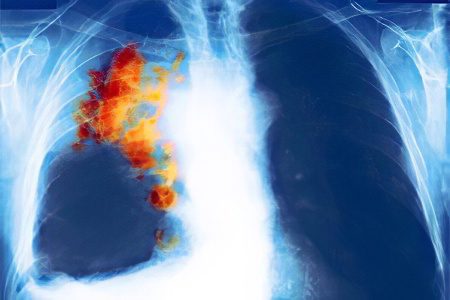 lung cancer x-ray