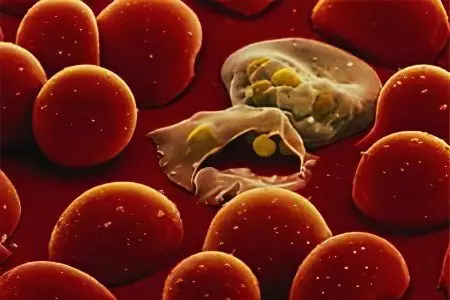 Malaria: first symptoms and treatment