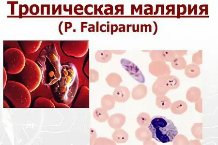 Malaria: first symptoms and treatment