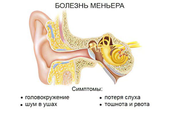 Meniere&#8217;s disease (syndrome)