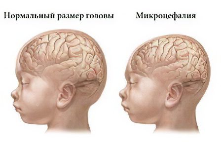 Microcephaly in children