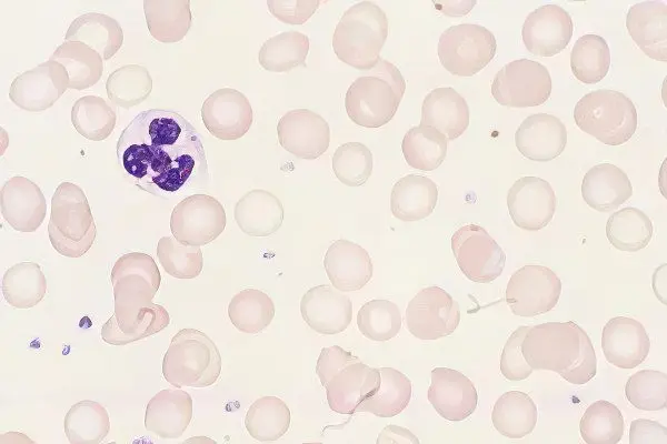 microcytic anemia