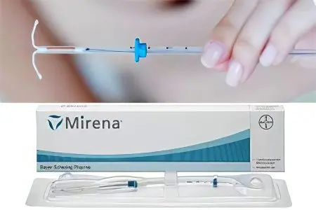 Mirena coil for endometriosis