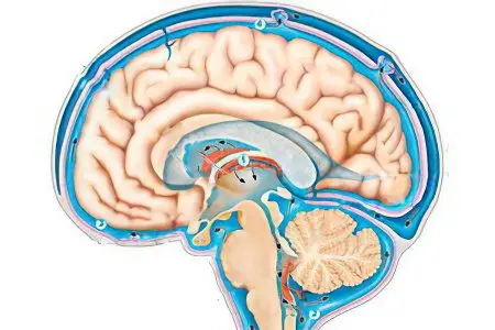 moderate hydrocephalus of the brain