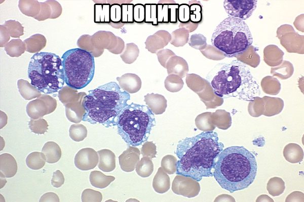 Monocytosis: causes, what is dangerous? How to treat?