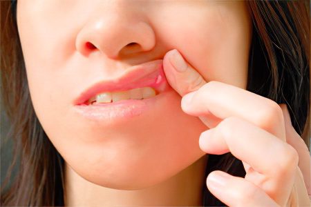 Mouth ulcers: how to treat?