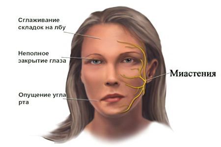 Myasthenia gravis: forms, symptoms and treatment