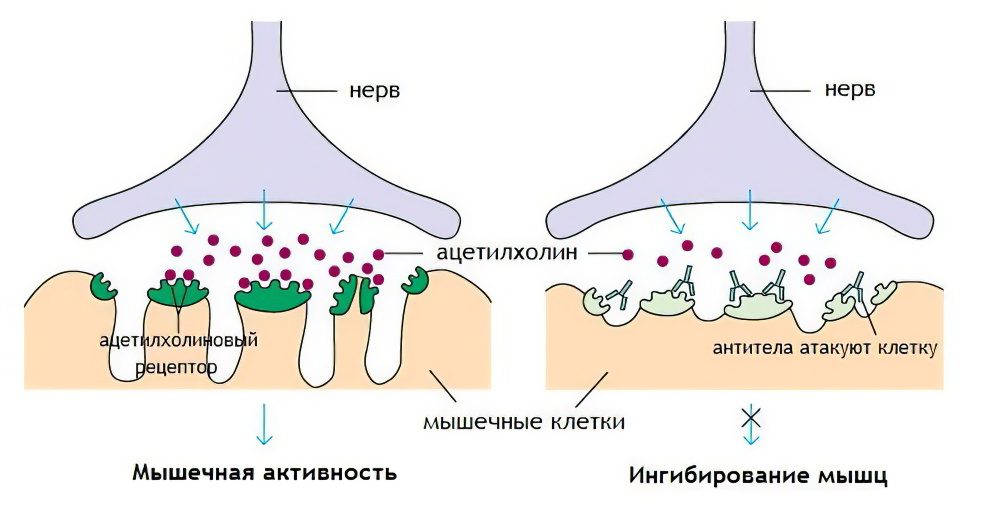 Myasthenia gravis: forms, symptoms and treatment