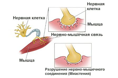 Myasthenia gravis: forms, symptoms and treatment