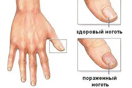 Nail fungus on hands