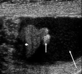 Necrosis of Morgagni&#8217;s hydatids and testicular hydatids