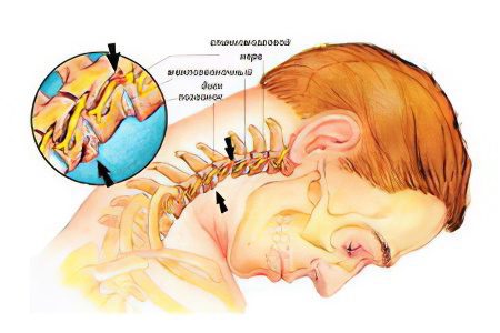 Nerve entrapment in the cervical spine