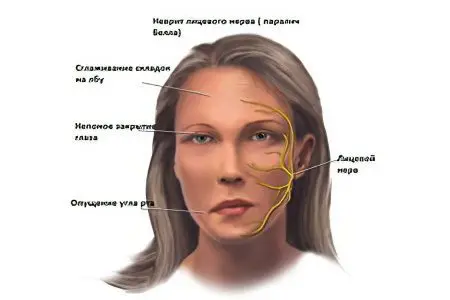 Neuritis of the facial nerve: symptoms and treatment