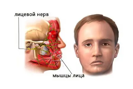 Neuritis of the facial nerve: symptoms and treatment